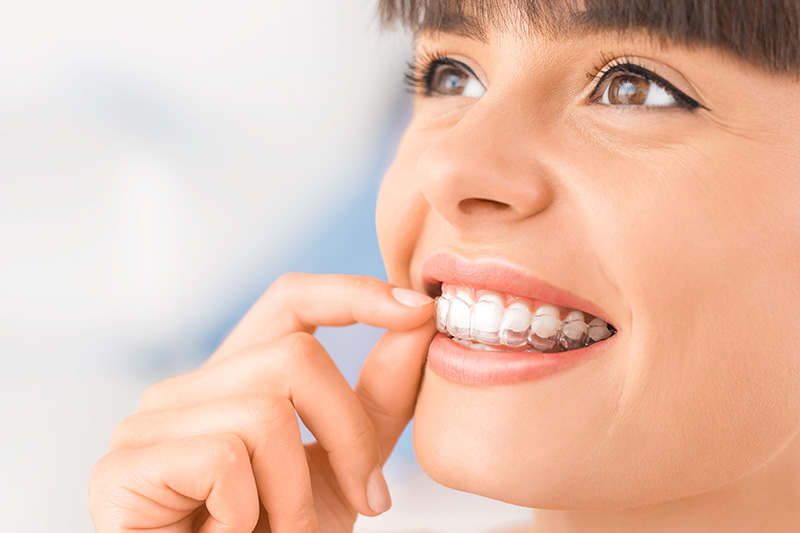 Clear Alignment Treatment - Dr. Evelyn Catuira, Diamond Bar Dentist