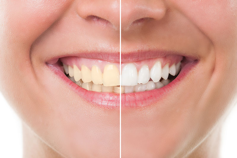 Teeth Whitening - Dr. Evelyn Catuira, Diamond Bar Dentist