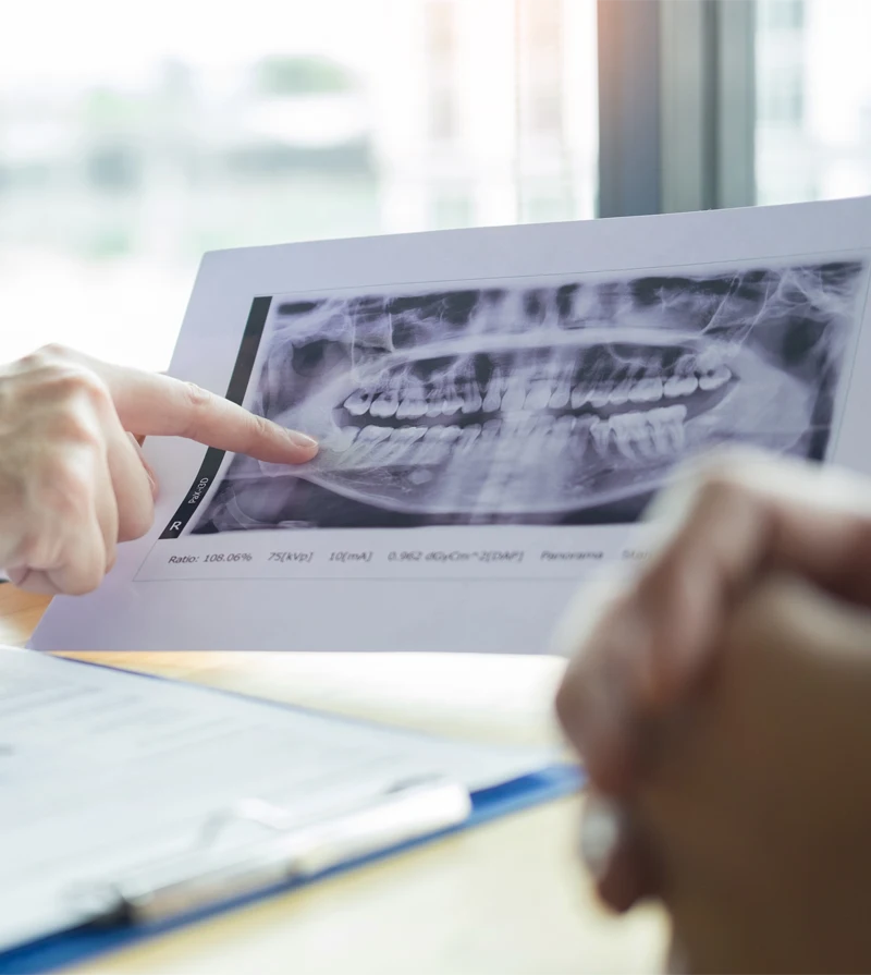 Hand pointing to a printed dental X-ray image during a consultation at a desk.